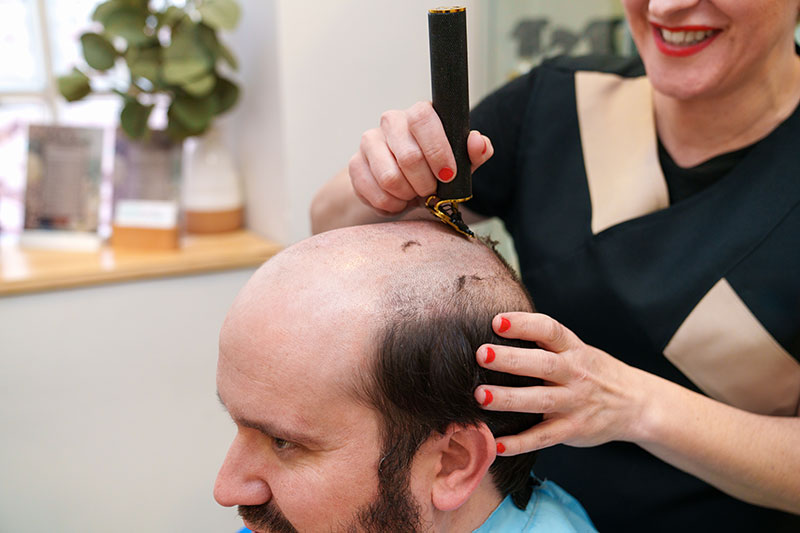 Magazine_hairloss_01