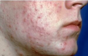 트레티바 10mg vs 40mg