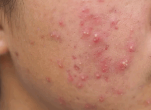 난치성여드름 여성