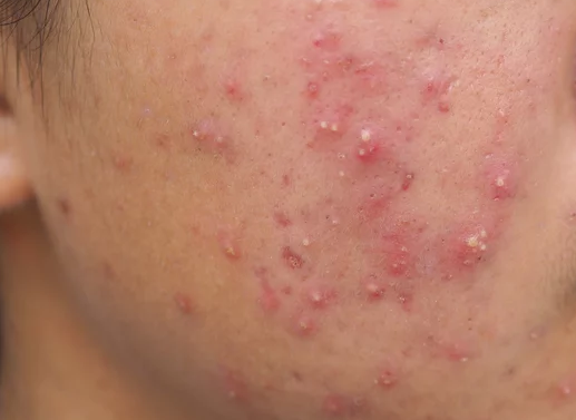 난치성여드름 여성