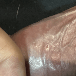 발라시클로버 성기포진