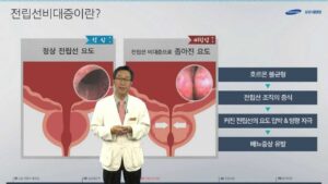 전립선비대증 치료