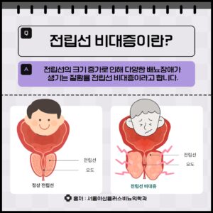 전립선비대증 발생