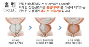 전립선비대증레이저 홈뮴레이저수술holmium laser 삼육부산병원