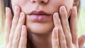 헤르페스 감염증