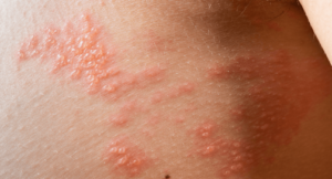 헤르페스 바이러스