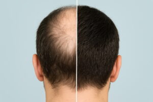 클라스코테론(Clascoterone)