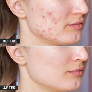 메트로니다졸(Metrogyl Gel)