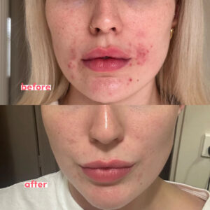 메트로니다졸(Metrogyl Gel)